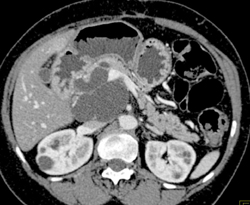 Cystadenoma - CTisus CT Scan