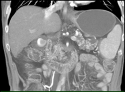 Multiple Pancreatic Cysts - CTisus CT Scan