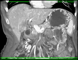 Encases Superior Mesenteric Artery (SMA) and Superior Mesenteric Vein (SMV) With Collaterals - CTisus CT Scan