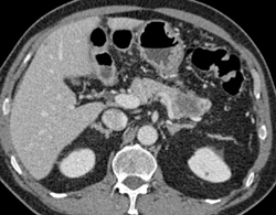 Carcinomatosis With Pancreatic Cancer - CTisus CT Scan