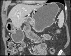 Post Whipple - CTisus CT Scan