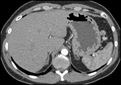 Thick Gastric Folds Due to Glucagonoma - CTisus CT Scan