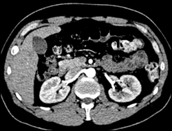 Glucagonoma in the Duodenum - CTisus CT Scan