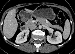 Splenic Artery Aneurysm Simulates An Insulinoma of the Pancreas - CTisus CT Scan