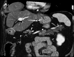 Multiple Intraductal Papillary Mucinous Neoplasms (IPMNs) - CTisus CT Scan