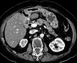 Multiple Intraductal Papillary Mucinous Neoplasms (IPMNs) - CTisus CT Scan