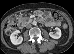 Adenocarcinoma Arising in A Intraductal Papillary Mucinous Neoplasm (IPMN) - CTisus CT Scan