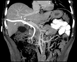 Pancreatic Cancer Invades the PV/SMV Confluence - CTisus CT Scan