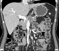 Pancreatic Cancer Invades the PV/SMV Confluence-with Impressive Collaterals - CTisus CT Scan