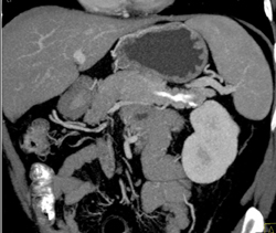 Contrast in Pancreatic Duct S/P ERCP - CTisus CT Scan