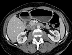 Intraductal Papillary Mucinous Neoplasm (IPMN) Off Uncinate - CTisus CT Scan