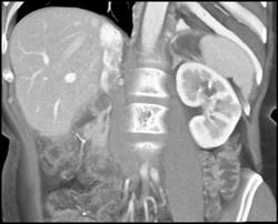 Intraductal Papillary Mucinous Neoplasm (IPMN) - CTisus CT Scan