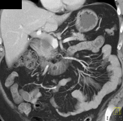 Intraductal Papillary Mucinous Neoplasm (IPMN) - CTisus CT Scan