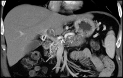 Chronic Pancreatitis - CTisus CT Scan