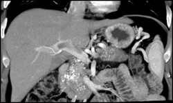 Chronic Pancreatitis - CTisus CT Scan