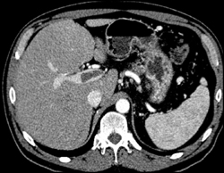 Chronic Pancreatitis - CTisus CT Scan