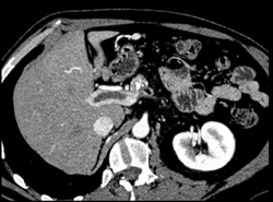 Portal Vein Thrombosis and Chronic Pancreatitis - CTisus CT Scan