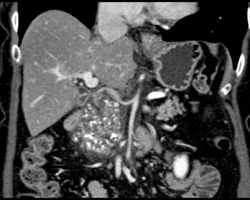 Chronic Pancreatitis - CTisus CT Scan