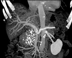 Chronic Pancreatitis - CTisus CT Scan