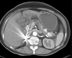 Multiple Vascular Pancreatic Masses Due to Renal Cell Carcinoma Metastatic to the Pancreas - CTisus CT Scan