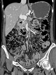 Pancreatic Cancer Encases PV/SMV Confluence - CTisus CT Scan