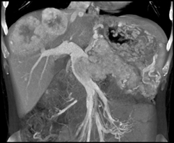 Islet Cell Tumor of the Pancreas Invades the Portal Vein With Vascular Liver Metastases Also Seen - CTisus CT Scan