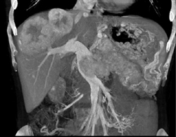 Islet Cell Tumor of the Pancreas Invades the Portal Vein With Vascular Liver Metastases Also Seen - CTisus CT Scan