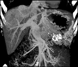 Islet Cell Tumor of the Pancreas Invades the Portal Vein With Vascular Liver Metastases Also Seen - CTisus CT Scan