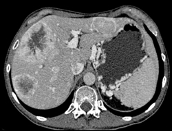 Islet Cell Tumor of the Pancreas Invades the Portal Vein With Vascular Liver Metastases Also Seen - CTisus CT Scan