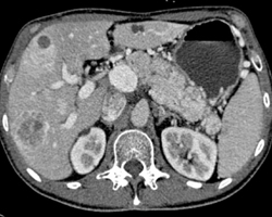 Islet Cell Tumor of the Pancreas Invades the Portal Vein With Vascular Liver Metastases Also Seen - CTisus CT Scan