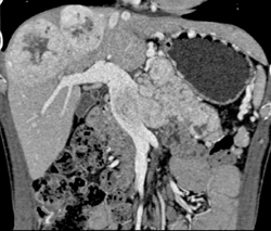 Islet Cell Tumor of the Pancreas Invades the Portal Vein With Vascular Liver Metastases Also Seen - CTisus CT Scan