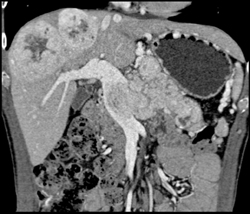 Islet Cell Tumor of the Pancreas Invades the Portal Vein With Vascular Liver Metastases Also Seen - CTisus CT Scan