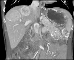 Islet Cell Tumor of the Pancreas Invades the Portal Vein With Vascular Liver Metastases Also Seen - CTisus CT Scan