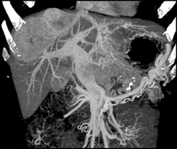 Islet Cell Tumor of the Pancreas Invades the Portal Vein With Vascular Liver Metastases Also Seen - CTisus CT Scan