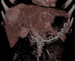 Islet Cell Tumor of the Pancreas Invades the Portal Vein With Vascular Liver Metastases Also Seen - CTisus CT Scan