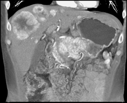 Islet Cell Tumor of the Pancreas Invades the Portal Vein With Vascular Liver Metastases Also Seen - CTisus CT Scan