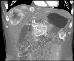 Islet Cell Tumor of the Pancreas Invades the Portal Vein With Vascular Liver Metastases Also Seen - CTisus CT Scan