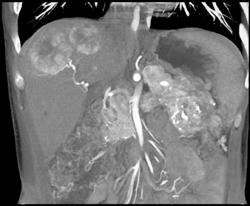 Islet Cell Tumor of the Pancreas Invades the Portal Vein With Vascular Liver Metastases Also Seen - CTisus CT Scan