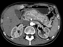 Islet Cell Tumor of the Pancreas Invades the Portal Vein With Vascular Liver Metastases Also Seen - CTisus CT Scan