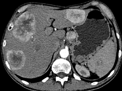 Islet Cell Tumor of the Pancreas Invades the Portal Vein With Vascular Liver Metastases Also Seen - CTisus CT Scan