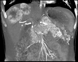 Islet Cell Tumor of the Pancreas Invades the Portal Vein With Vascular Liver Metastases Also Seen - CTisus CT Scan