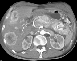 Islet Cell Tumor of the Pancreas Invades the Portal Vein With Vascular Liver Metastases Also Seen - CTisus CT Scan