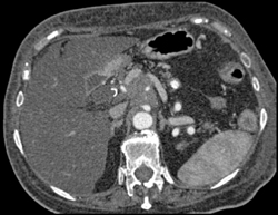 Pancreatic Cancer Encases Celiac Artery With Portal Vein Thrombosis Also Seen - CTisus CT Scan