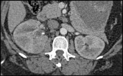 Acute Pyelonephritis-right Kidney-presented Clinically Like Pancreatitis With Ruq Pain - CTisus CT Scan