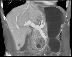 Pancreatic Adenocarcinoma - CTisus CT Scan