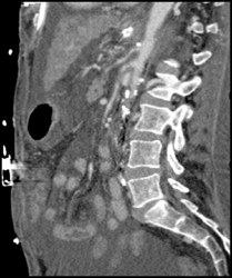 Narrowed Celiac and SMA Leads to Ischemia - CTisus CT Scan