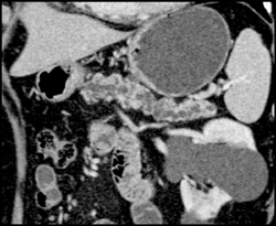 Dilated Pancreatic Duct With Multiple Intraductal Papillary Mucinous Neoplasms (IPMNs) - CTisus CT Scan