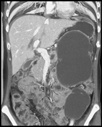 Pancreatic Laceration With Pseudocyst - CTisus CT Scan