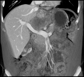 Peri-pancreatic Mass Invades the Portal Vein - CTisus CT Scan