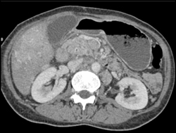 Acute Pancreatitis With Left Gonadal Thrombosis - CTisus CT Scan